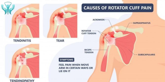 What is Rotator Cuff Injury, let’s know about it